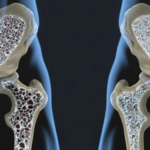 jornadas patologias tiroideas osteoporosis